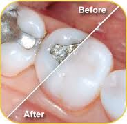 White Fillings